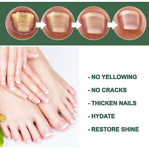 Fast Nail Fungal Treatments Nail Repair Essences Serum Care Treatments Foot Nail Fungus Removal Gel Paronychia Onychomycosis