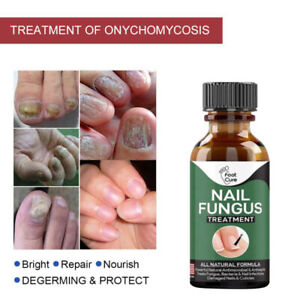 Fast Nail Fungal Treatments Nail Repair Essences Serum Care Treatments Foot Nail Fungus Removal Gel Paronychia Onychomycosis