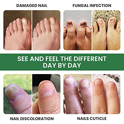 Fast Nail Fungal Treatments Nail Repair Essences Serum Care Treatments Foot Nail Fungus Removal Gel Paronychia Onychomycosis