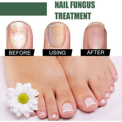 Fast Nail Fungal Treatments Nail Repair Essences Serum Care Treatments Foot Nail Fungus Removal Gel Paronychia Onychomycosis